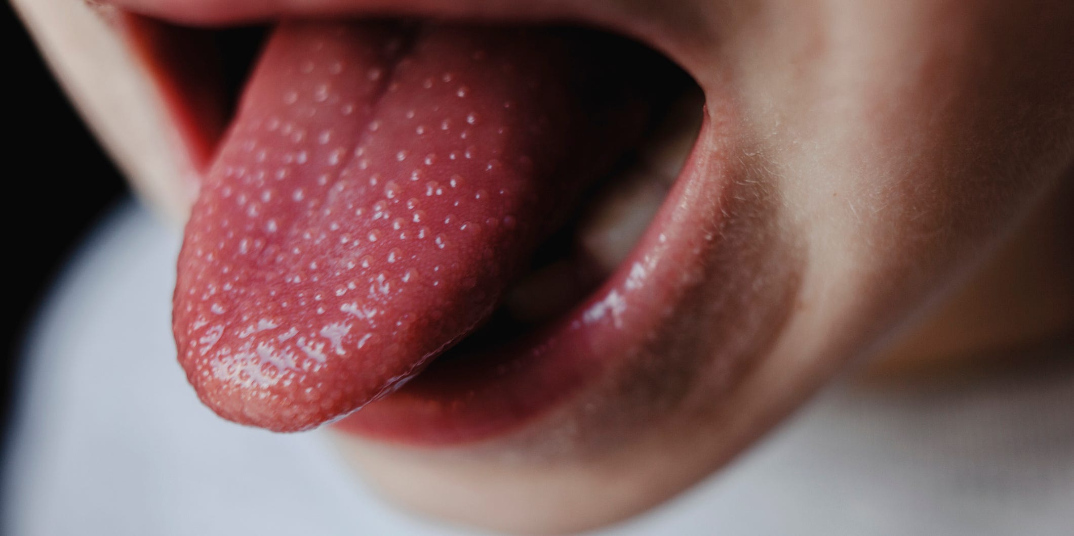 Langue avec papilles irritées