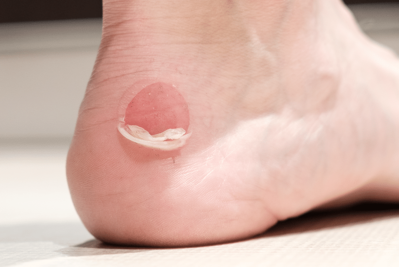 Ampoule au pied
