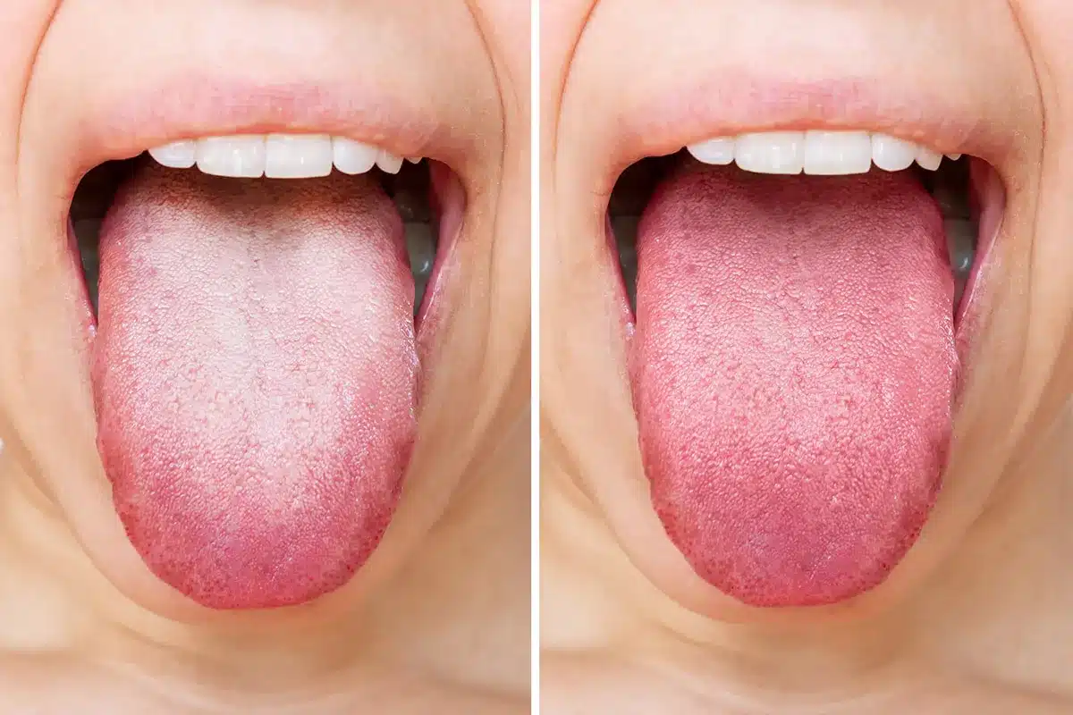 Comparaison de langues saines et pathologiques