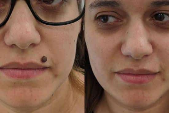 Techniques naturelles pour atténuer les grains de beauté
