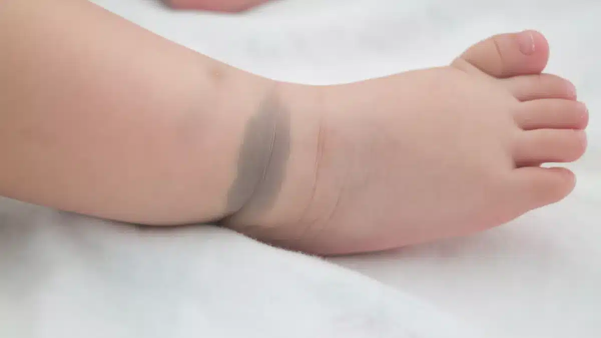 Tache de naissance sur un bébé