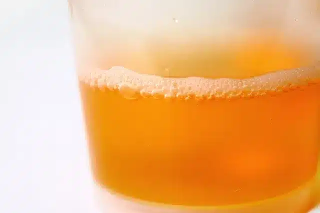 Verre contenant des urines mousseuses