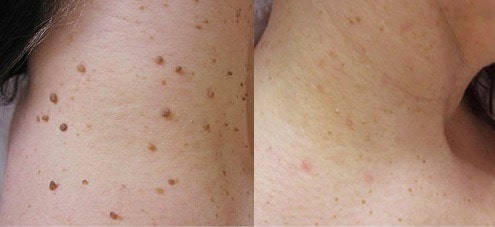 Comparaison avant/après traitement naturel contre les verrues