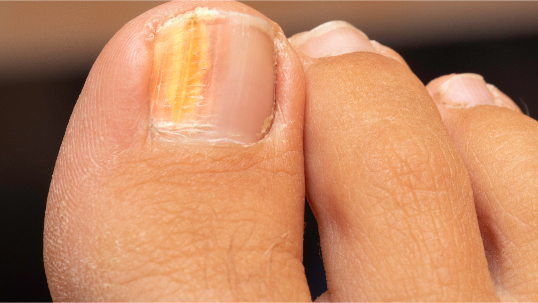 Ongles jaunes