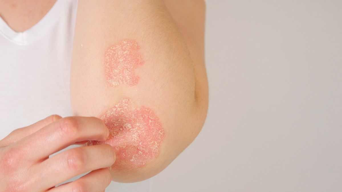 Image illustrative du psoriasis sur la peau