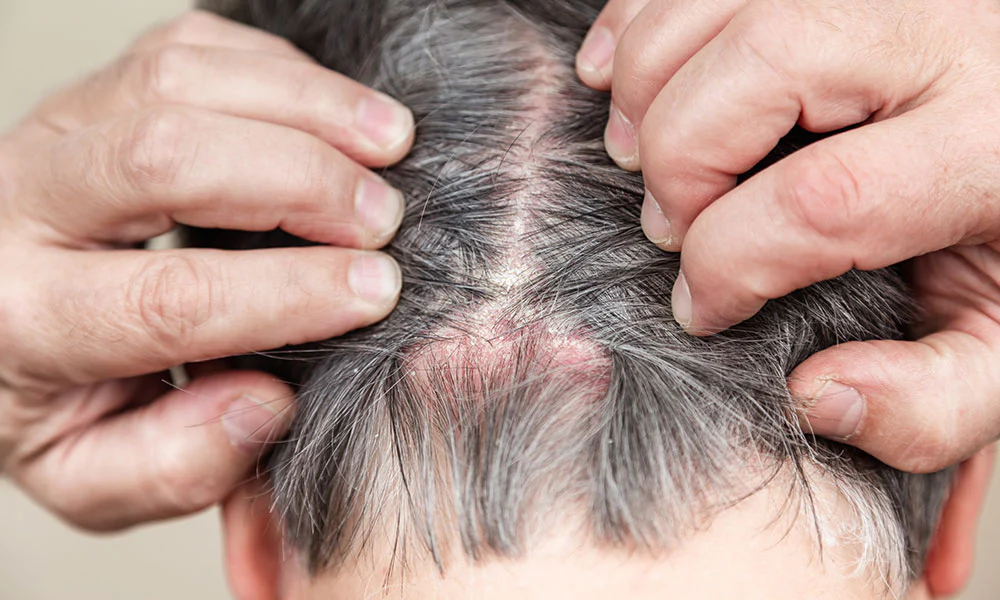 Plaques de psoriasis sur le cuir chevelu
