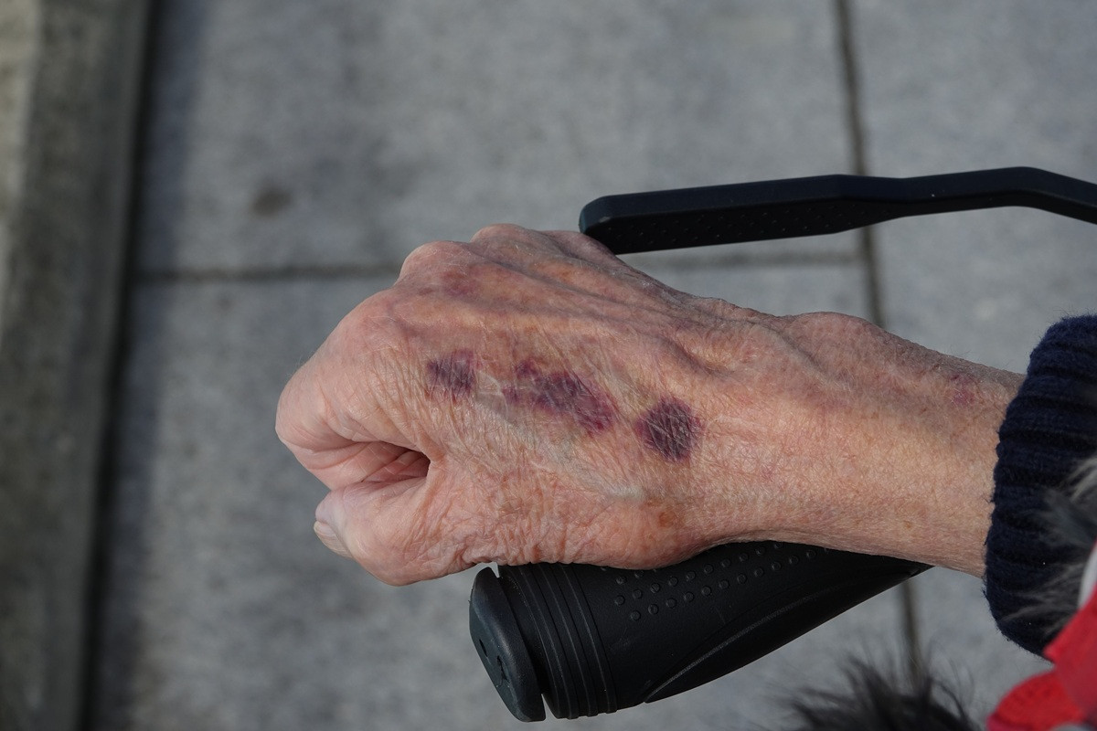 Image présentant différents facteurs contribuant aux ecchymoses chez les personnes âgées