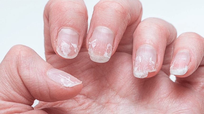 Ongles fragiles et dédoublés