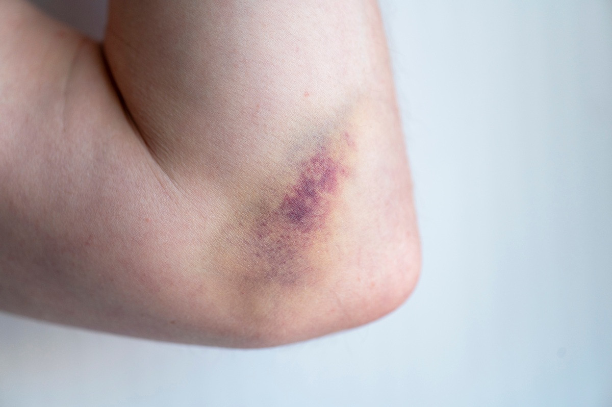 Illustration d'une personne âgée présentant des hématomes sur la peau