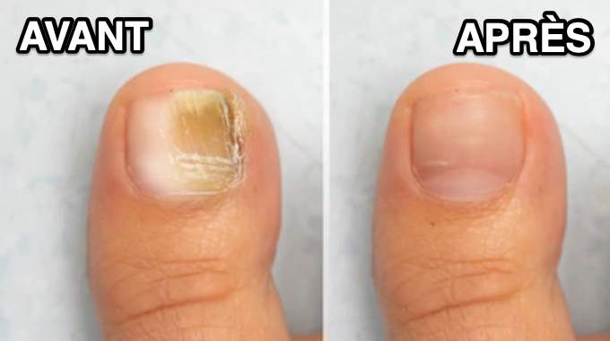 Préparation d'un soin pour les ongles à base de laurier