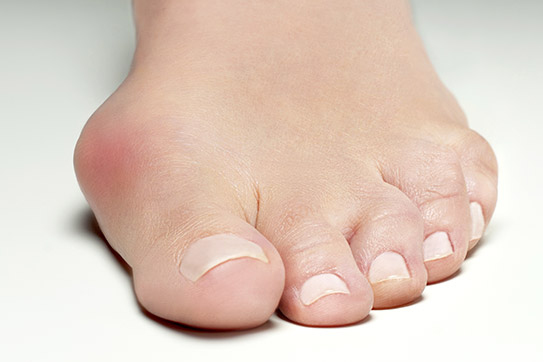 hallux valgus au pied