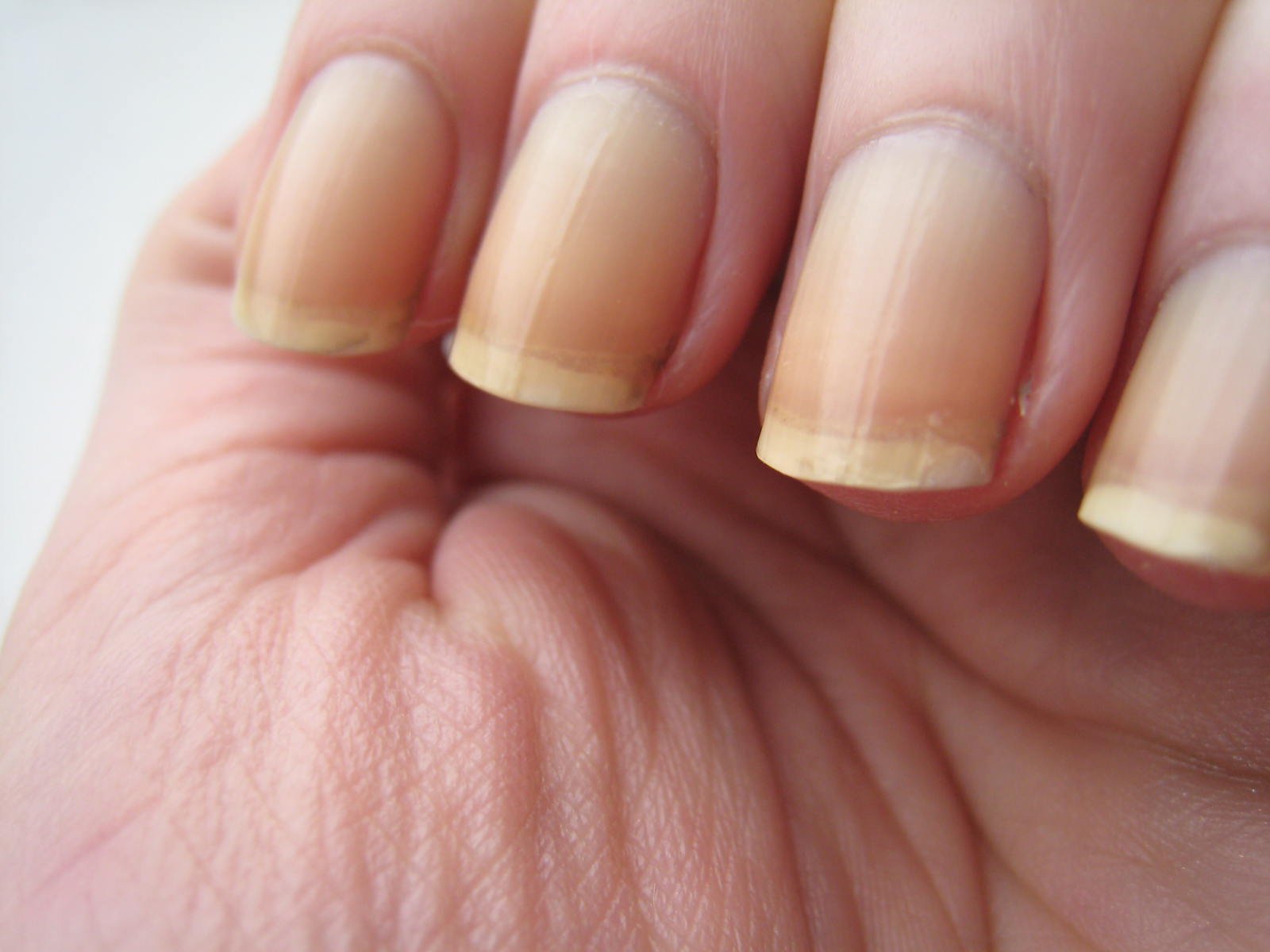 Ongles striés avec taches blanches