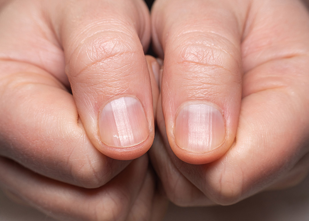 Ongle avec stries horizontales
