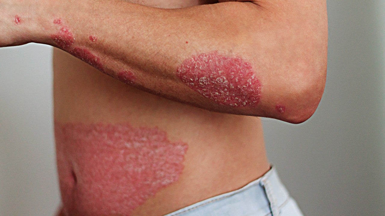 Symptômes visibles du psoriasis sur différentes parties du corps