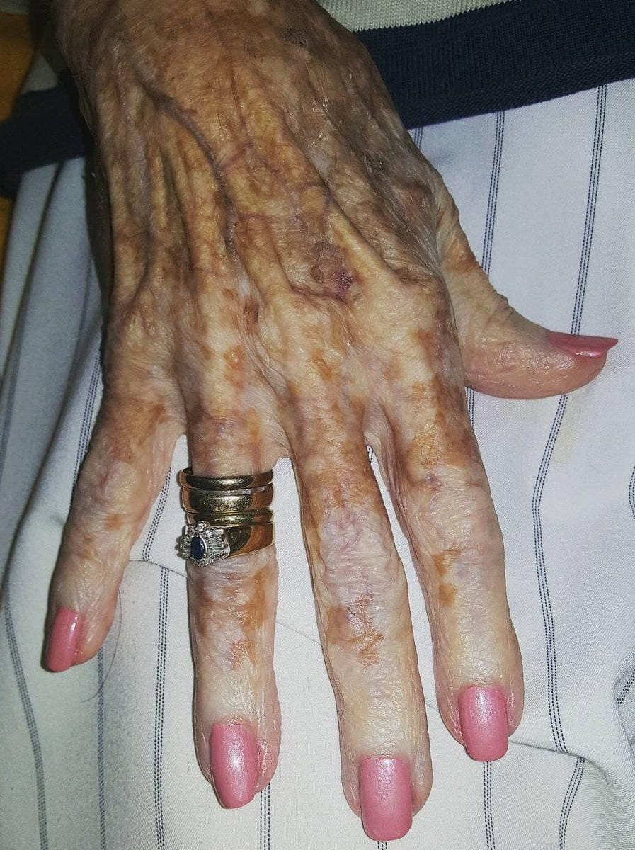 Main d'une personne âgée recevant un soin estnétique