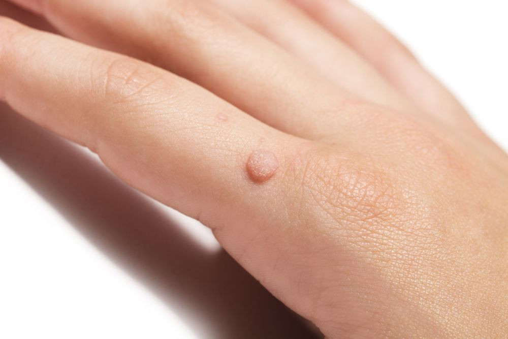 Application de latex sur une verrue