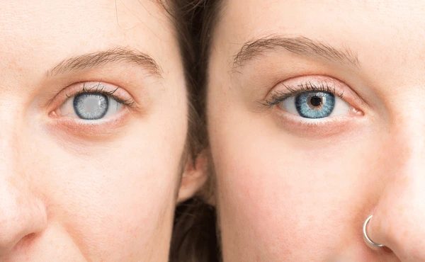 Femme montrant l'état de ses yeux avant et après un soin